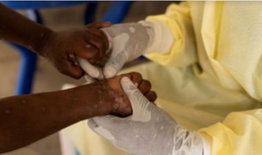 अफ्रीका में कहर बरपा रहा एमपॉक्स, 70 हजार के करीब पहुंची पीड़ितों की संख्या