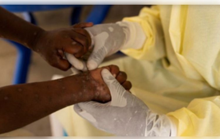 अफ्रीका में कहर बरपा रहा एमपॉक्स, 70 हजार के करीब पहुंची पीड़ितों की संख्या